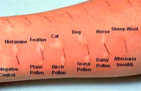 Гистамин аллергическая проба