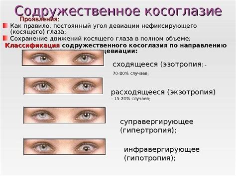 Глаз косит в сторону у взрослого: что это?