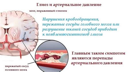 Глиоз - что это такое и как он связан с медициной?