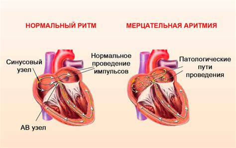 Глип сердца - что это?