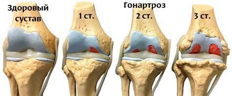 Гонартроз коленного сустава 1 степени