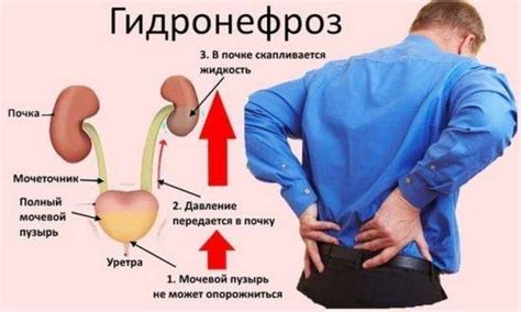 Гормональные нарушения и их последствия для стенок почек