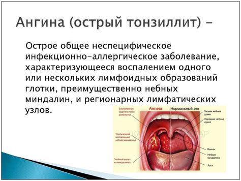 Грудная ангина: понятие и симптомы