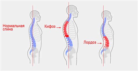 Грудной кифоз: симптомы и причины