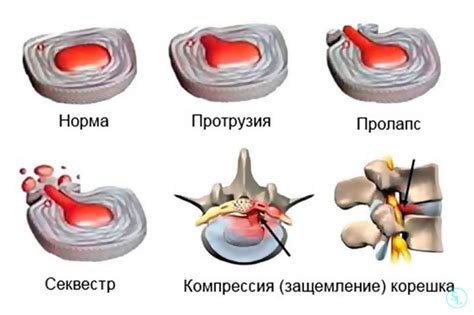 Грыжа: понятие и симптомы