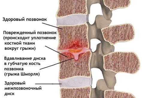 Грыжа шморля грудного отдела позвоночника