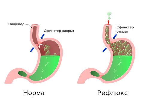 Гэрб желудка и его симптомы