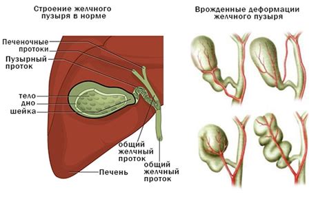 Г образный желчный пузырь: особенности и проявление проблем