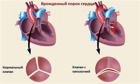 Дегенеративные изменения в сердце