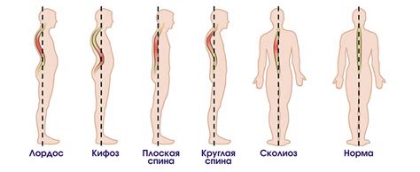 Деформации позвоночника у детей