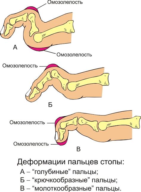 Деформация пальца Хитрона