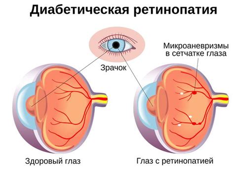 Диабетическая ретинопатия