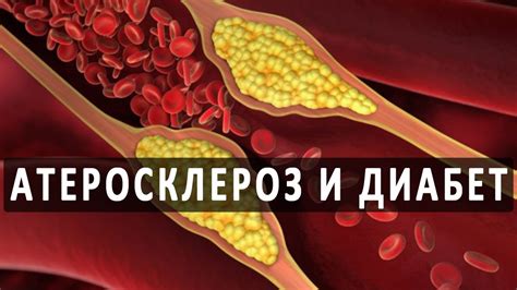 Диабет и атеросклероз БЦА