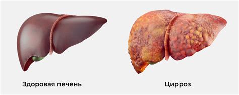 Диагностика алкогольного цирроза печени