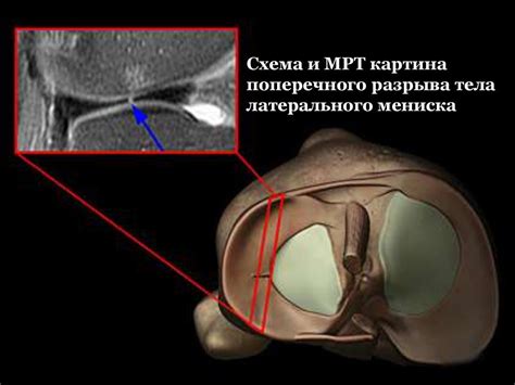 Диагностика блокады коленного сустава