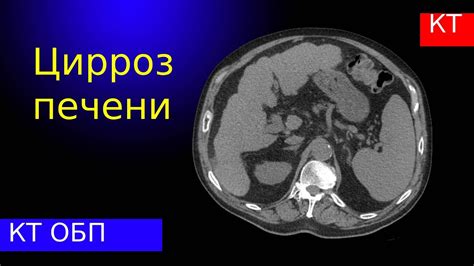 Диагностика бугристого контура печени