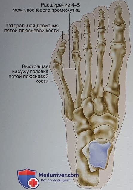 Диагностика варусной стопы