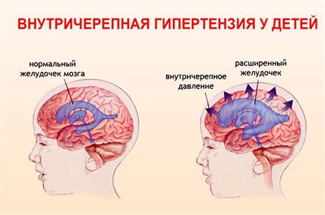 Диагностика внутричерепной гипертензии у детей