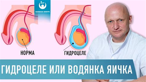 Диагностика водянки яичка