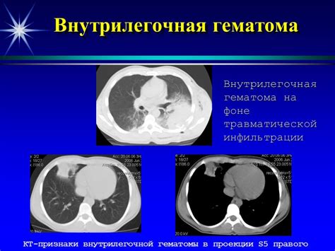 Диагностика выпирающей грудины