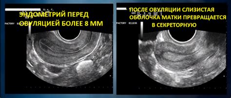 Диагностика доминантного фолликула с помощью УЗИ: что это значит?