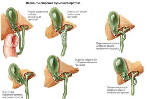 Диагностика изгиба желчного пузыря