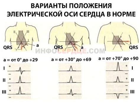 Диагностика и лечение отклонения эос влево