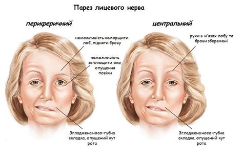 Диагностика и лечение пареза лицевого нерва