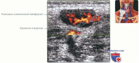 Диагностика и лечение реактивно измененного лимфоузла