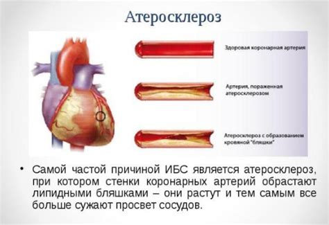 Диагностика и лечение стеноза сосудов сердца на 90 процентов