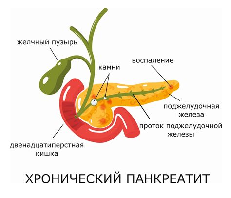 Диагностика и методы лечения обострения панкреатита