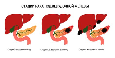 Диагностика и стадии заболевания