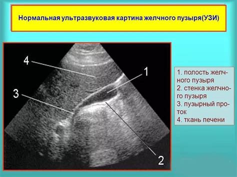 Диагностика маленького желчного пузыря