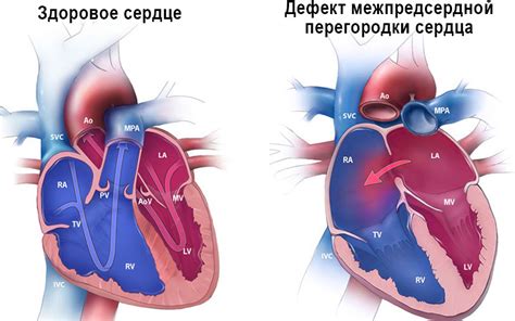 Диагностика межпредсердной перегородки у ребенка