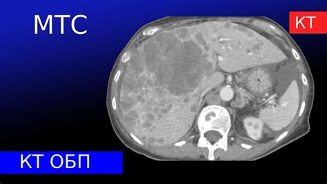 Диагностика метастазов в печени