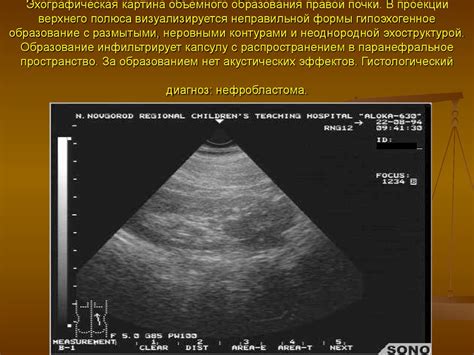 Диагностика микролита правой почки