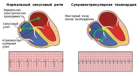 Диагностика наджелудочковой экстрасистолии