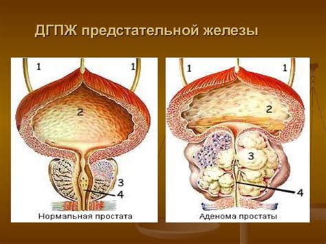 Диагностика неопластического процесса предстательной железы