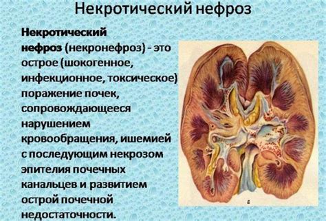 Диагностика нефроза 1 степени