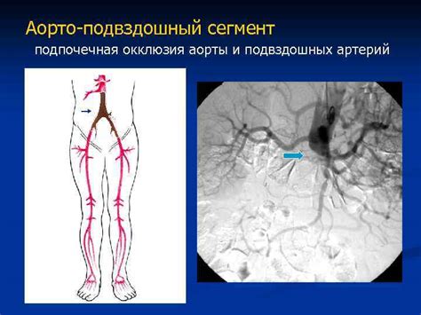 Диагностика окклюзии артерий голени