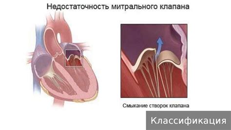 Диагностика оторвавшегося сердечного клапана