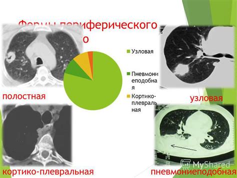 Диагностика падения легкого