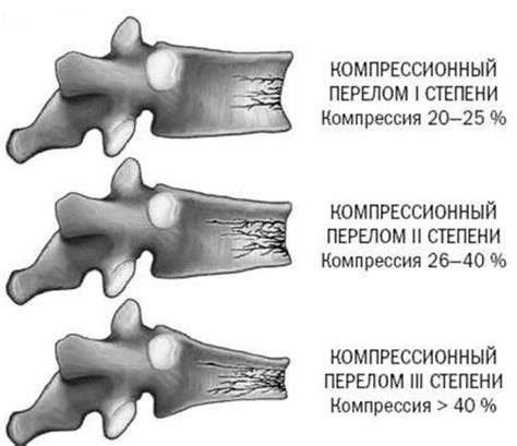 Диагностика перелома 3 степени