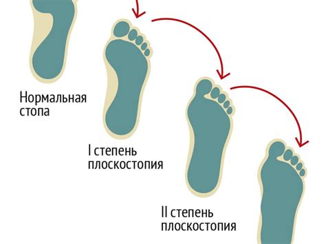 Диагностика плоскостопия 1 степени у подростка