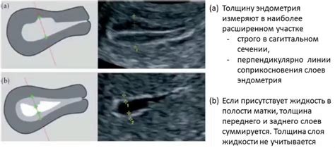 Диагностика повышенной толщины эндометрия