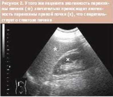 Диагностика повышенной эхогенности поджелудочной железы