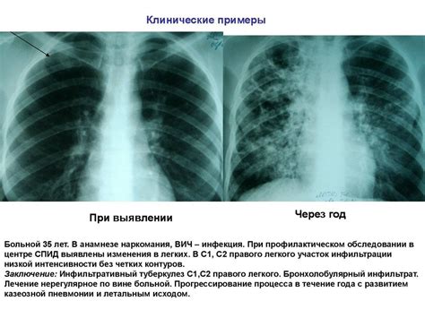 Диагностика полного распада легких