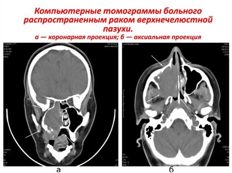 Диагностика снижения пневматизации гайморовой пазухи