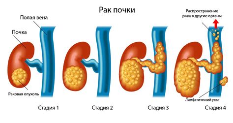 Диагностика структурного изменения почки