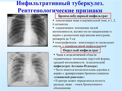 Диагностика схлопывания легких